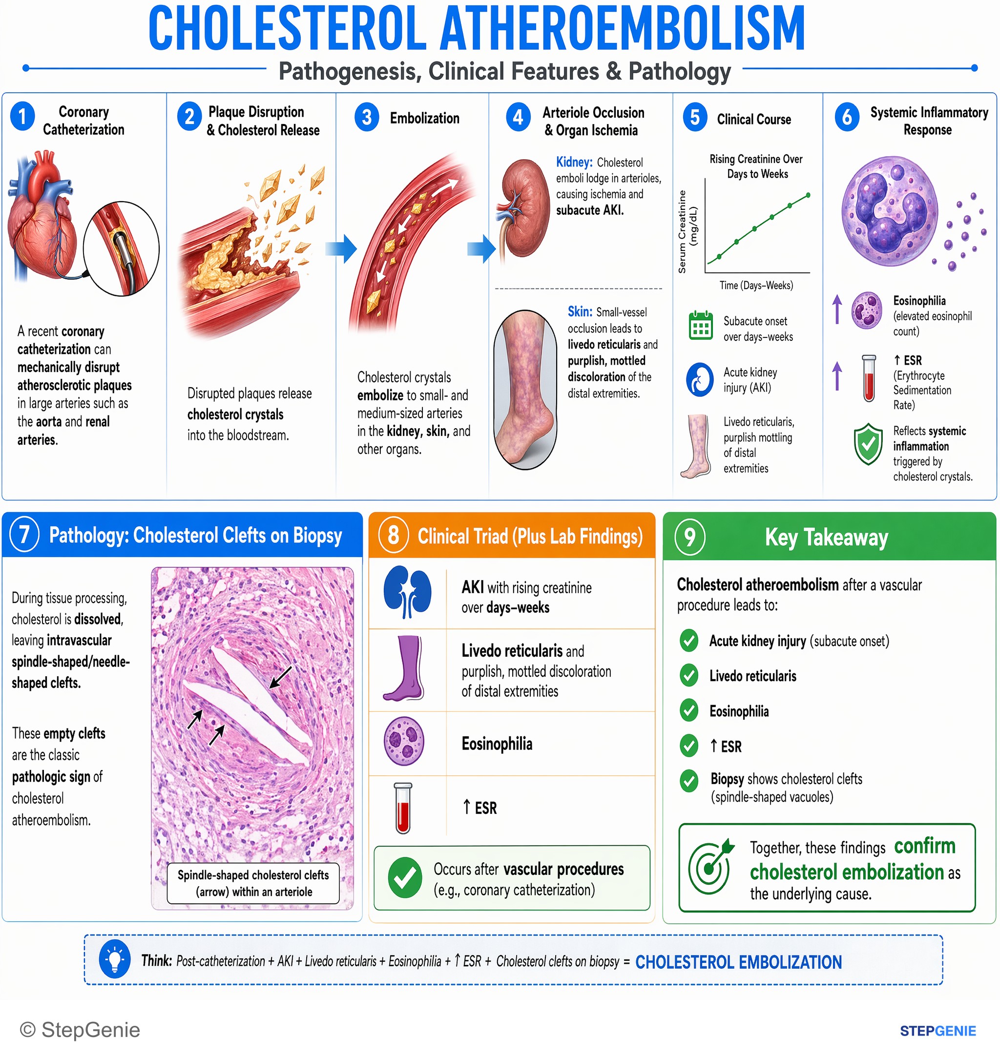 Step-by-step reasoning infographic: Cholesterol atheroembolism after vascular procedure → acute kidney injury, livedo reticularis, eosinophilia, ↑ESR; biopsy shows cholesterol clefts…