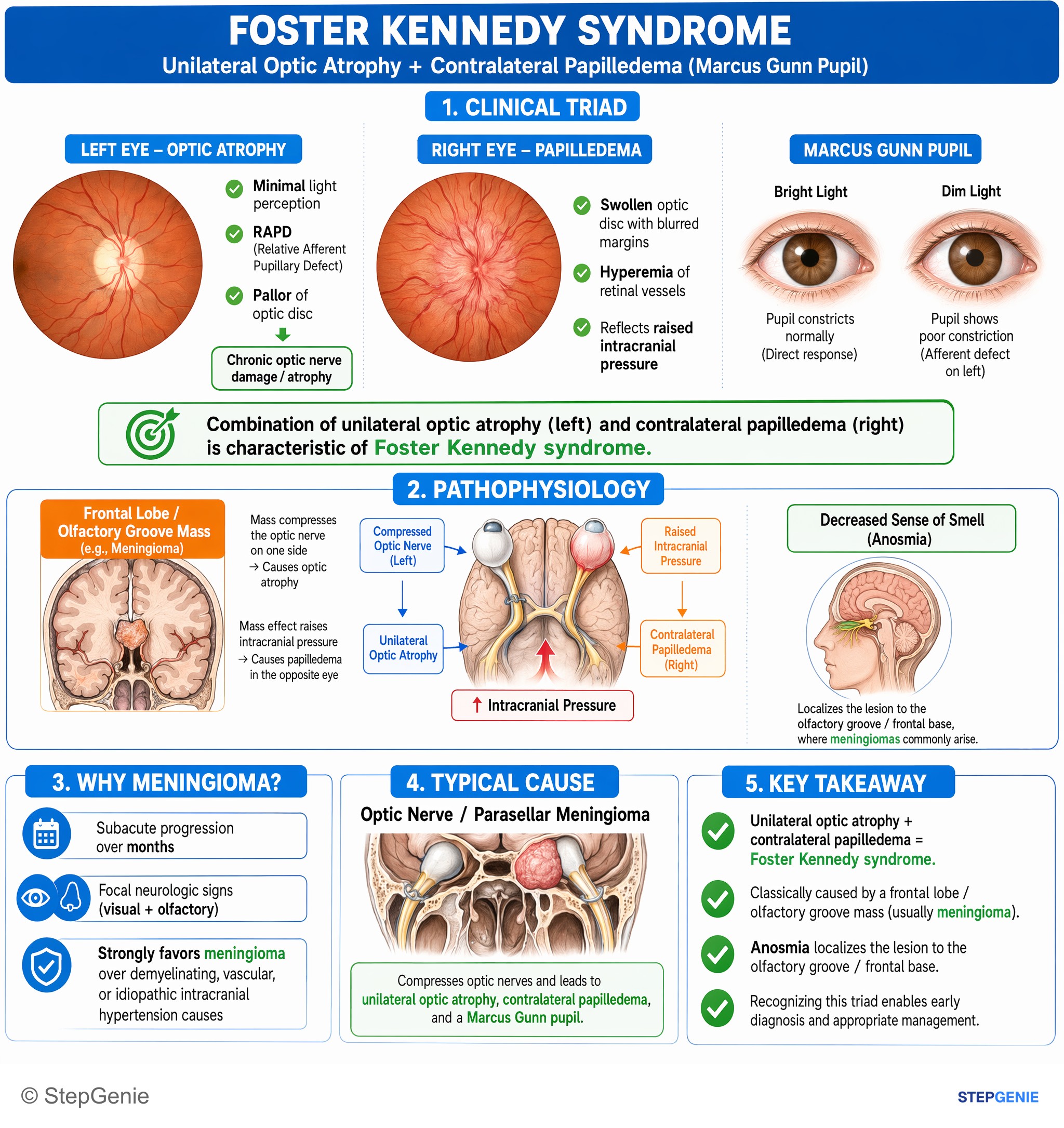 Tumors of the nervous system — StepGenie USMLE Step 2 explanation infographic