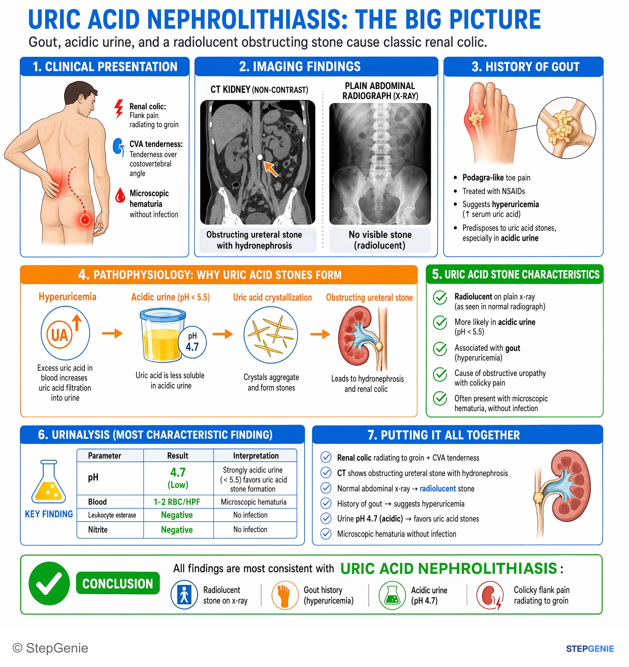 Nephrolithiasis and urinary tract obstruction — StepGenie USMLE Step 1 explanation infographic