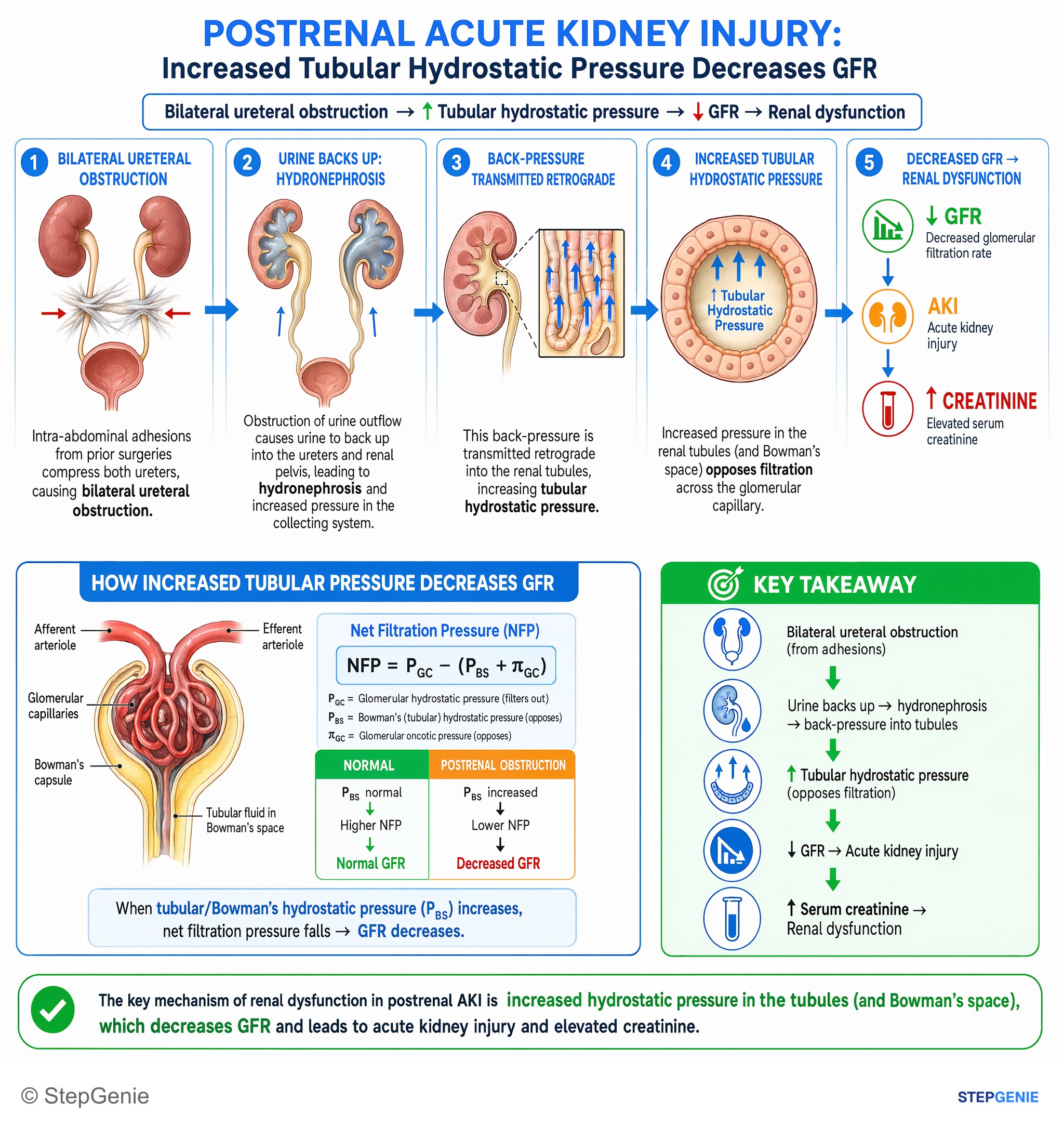 Acute kidney injury — StepGenie USMLE Step 1 explanation infographic
