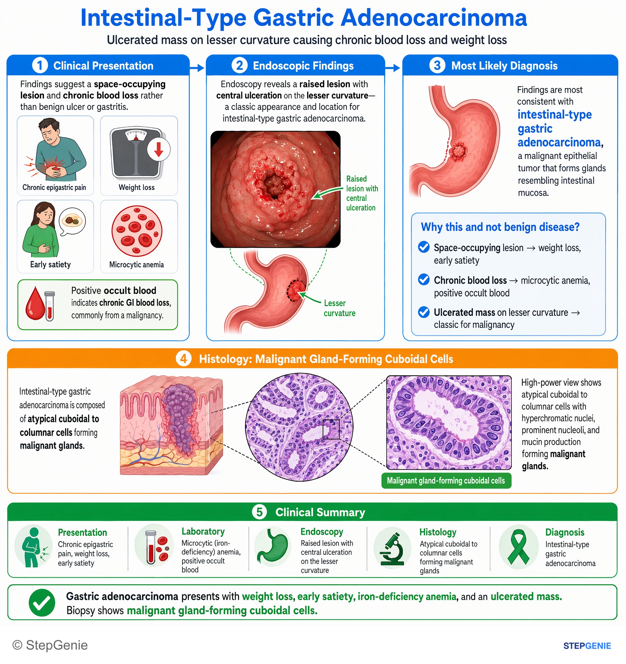 Tumors/Malignancy of the GI tract — StepGenie USMLE Step 1 explanation infographic