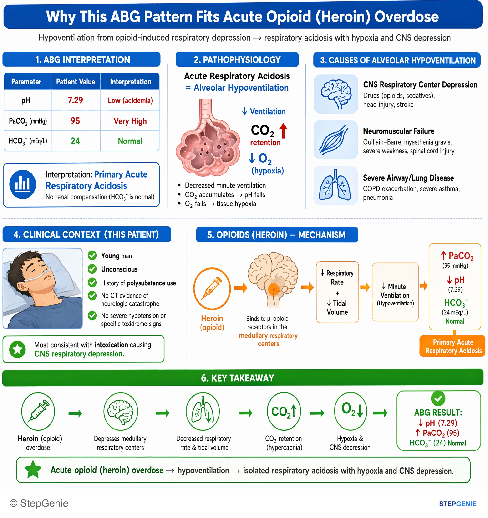 Step-by-step reasoning infographic: Acute opioid (heroin) overdose causes hypoventilation → isolated respiratory acidosis (↓pH, ↑PaCO₂, normal HCO₃⁻) with hypoxia and CNS depression.