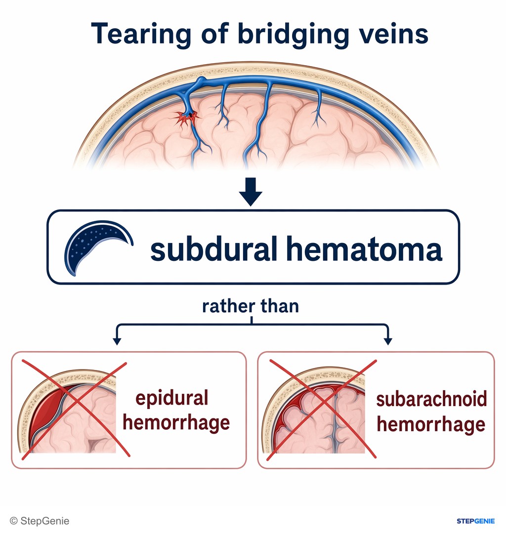 Reasoning step 3: Tearing of bridging veins classically causes a subdural hematoma rather than epidural or subarachnoid hemorrhage.