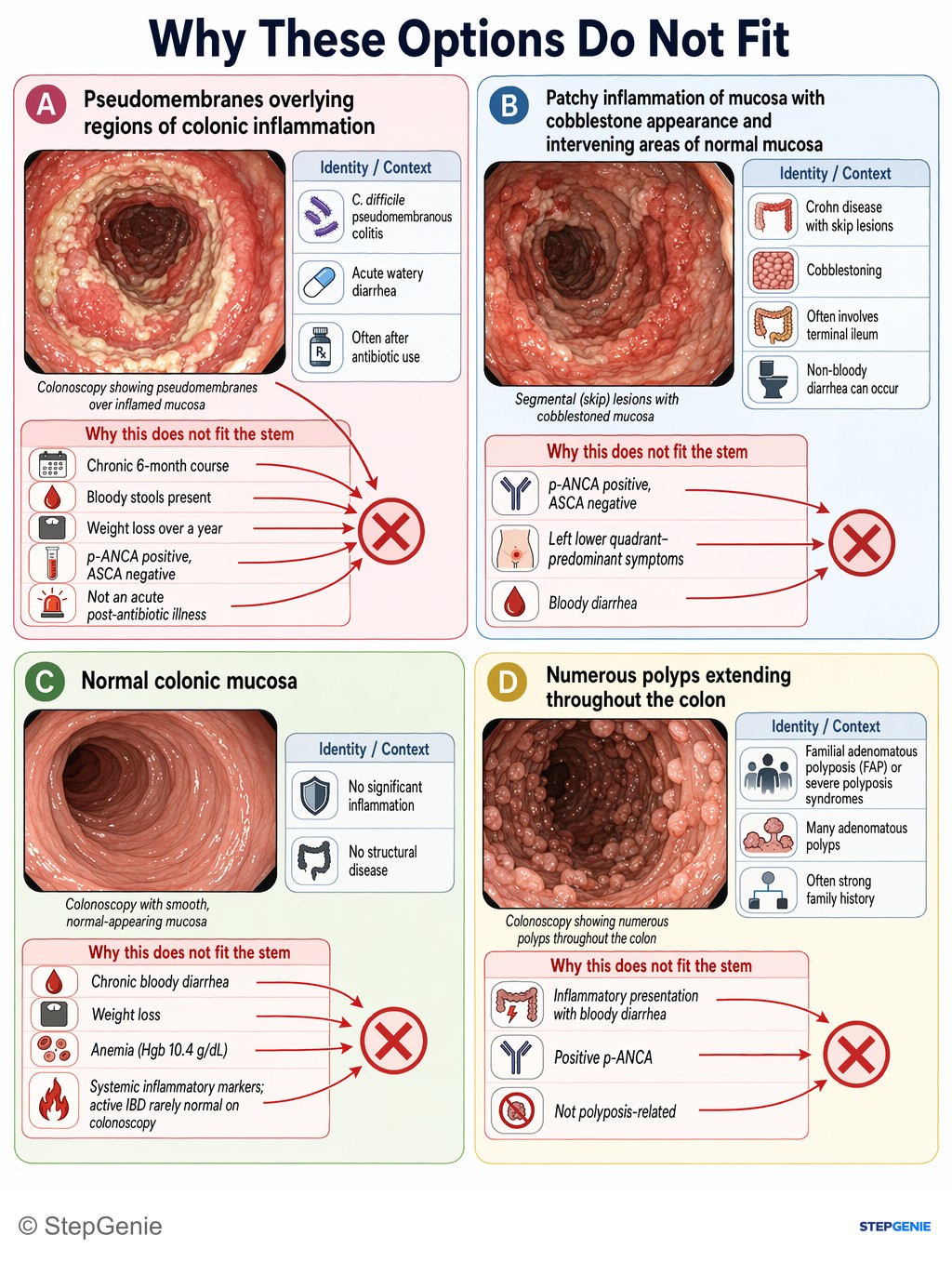 Why the other options are wrong: Ulcerative colitis: continuous colonic mucosal inflammation, bloody diarrhea, weight loss, positive p-ANCA; colonoscopy shows…